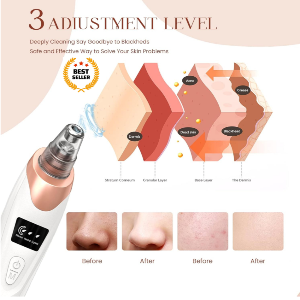 5-in-1 Blackhead Remover